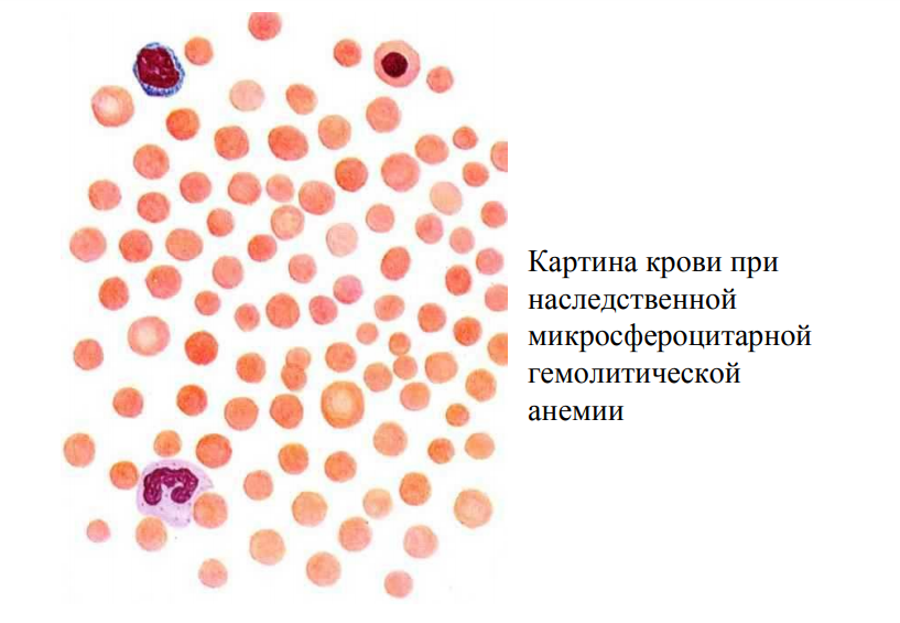 Анемия и вес. Апластическая анемия мазок крови. Гипопластическая анемия картина крови. Апластические анемии картина крови. Апластическая анемия картина периферической крови.