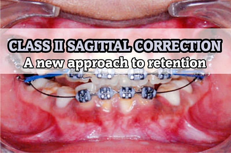 ORTHODONTICS A new approach to retention of Class II Sagittal correction
