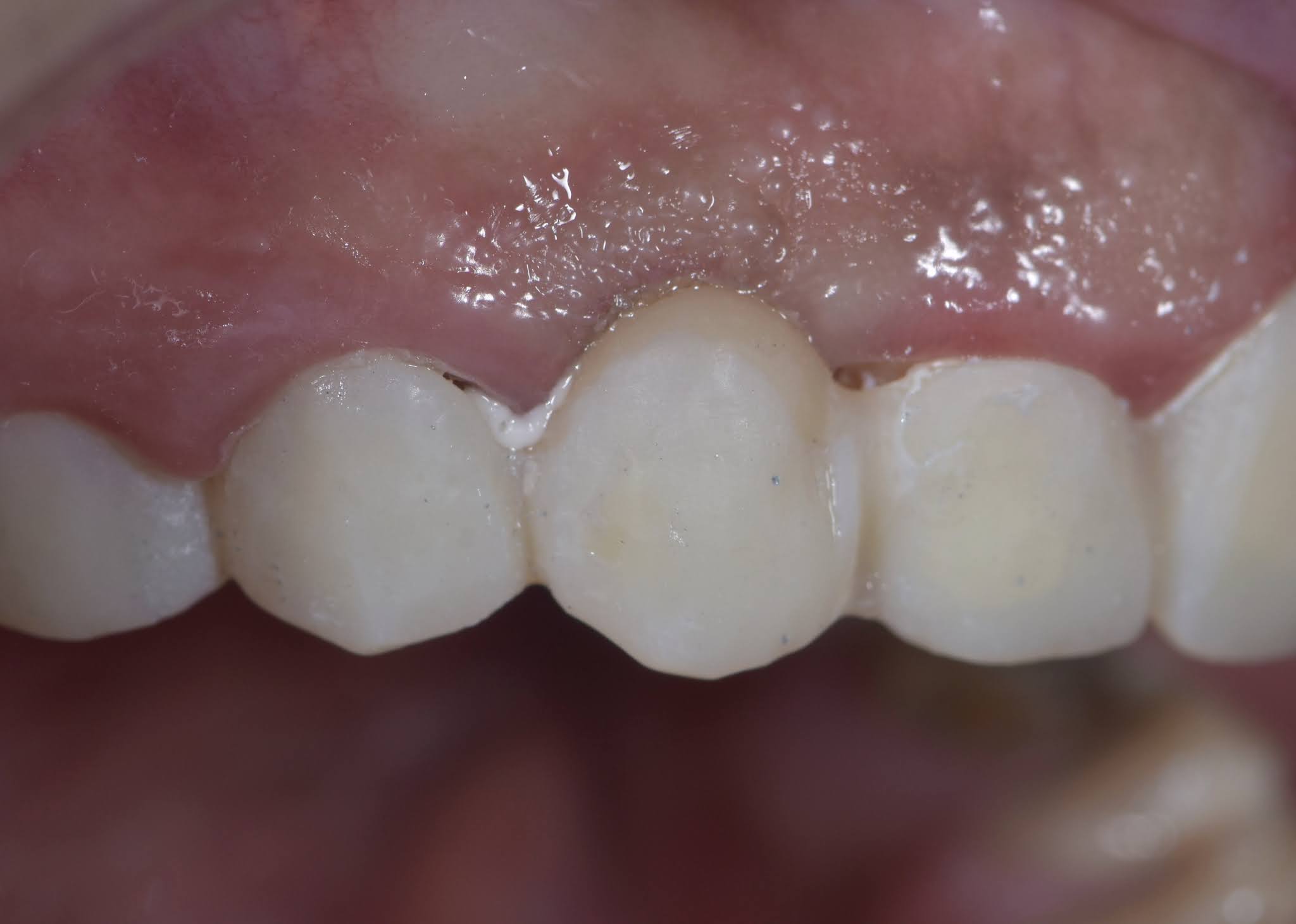 Dental Esthetics Ovate pontic for the correct emergence profile.. A clinical case