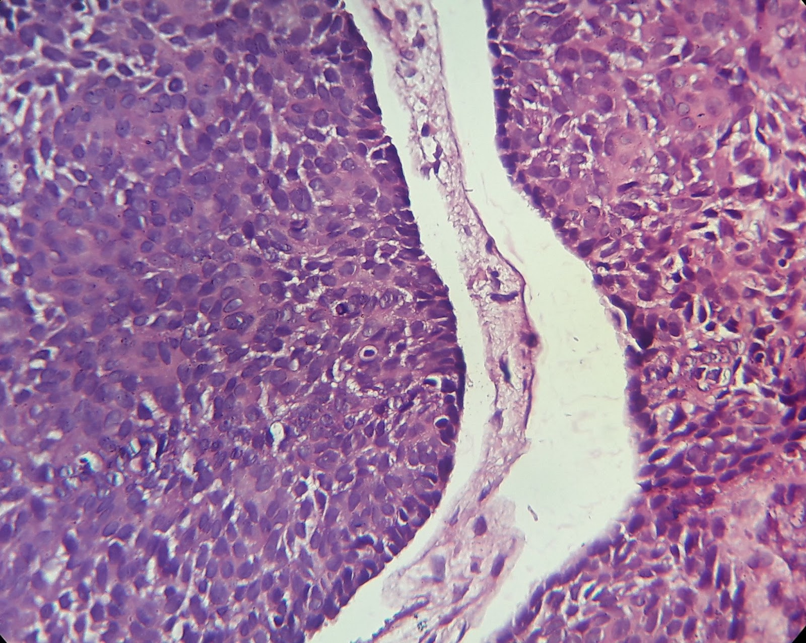 into the roots Basal cell carcinoma
