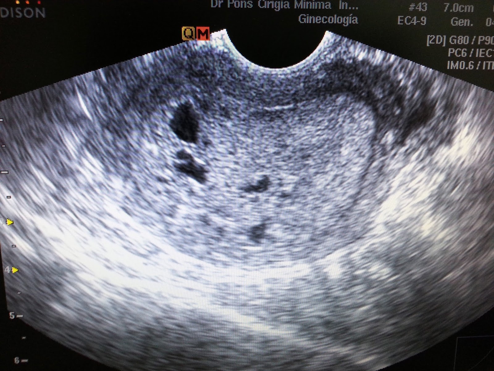 Cirugia Minima Invasiva Ginecologica Engrosamiento del endometrio. Que hago? Cirugia Minima Invasiva Ginecologica Engrosamiento del endometrio. Que hago?