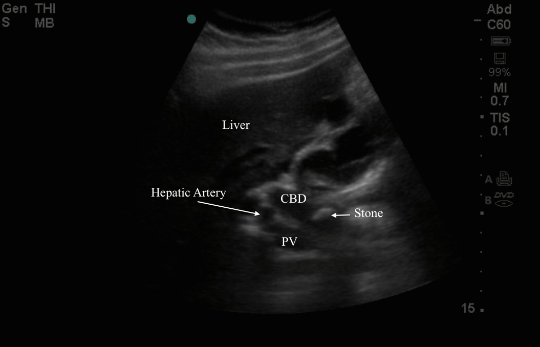 MEDICAL ULTRASOUND/STONE IN COMMON BILE DUCT