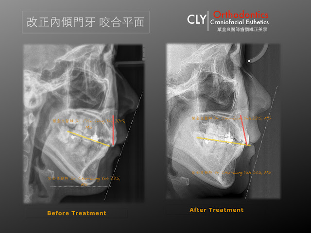 牙齒內傾！矯正後發生內傾！怎麼辦？