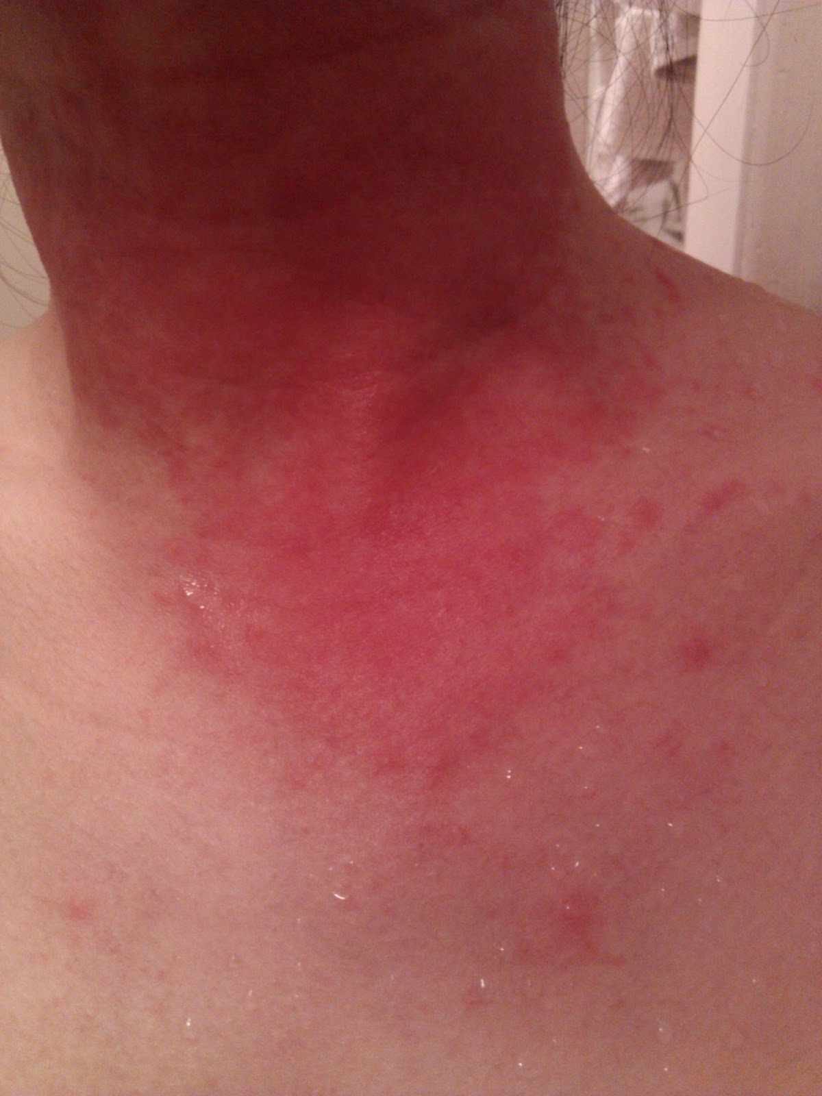 allergic reaction to bactrim