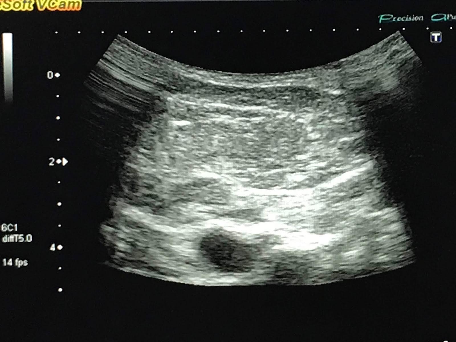 vietnamese-medic-ultrasound-case-542-neck-tumor-lipoma-dr-phan-thanh