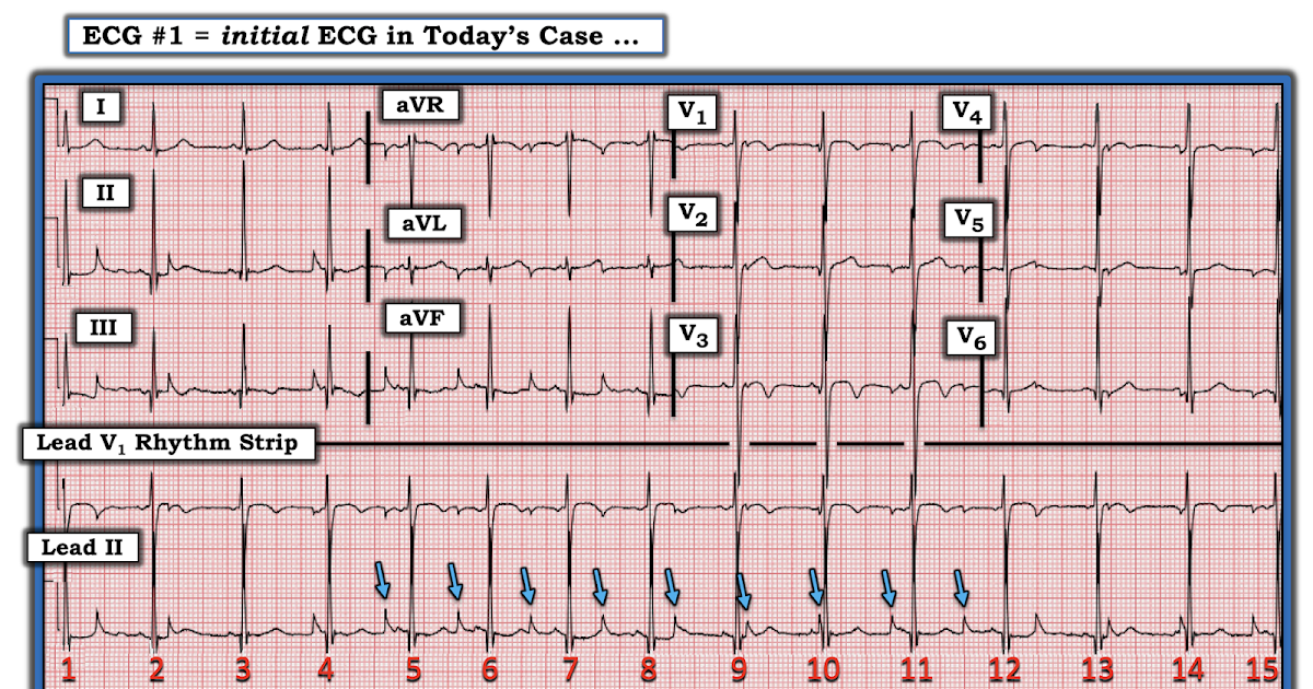 ECG Interpretation ECG Blog 255 (18) — Why AV Dissociation?