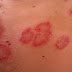 Comment soigner le psoriasis avec des méthodes naturelles