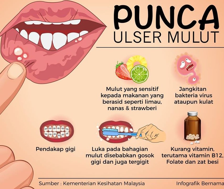Cara Mudah Atasi Ulser Mulut Bagi KanakKanak
