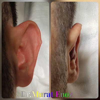 Otoplasty Operation For Protruding Ears in Istanbul