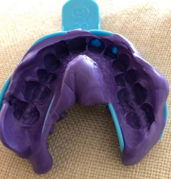 The Best (and Easiest) Way to Clean Your Mouth Guard