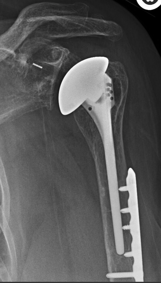 Shoulder Arthritis / Joint Replacement Stemless humeral prosthesis