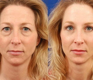 Find the best plastic surgery before and after results of eyelid surgery in Lahore by the best plastic surgeon in Lahore