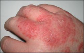 Dermatitis Atopik merupakan bentuk peradangan pada kulit yang bersifat kronik dan residifis yang sering terjadi pada bayi dan anak, disertai gatal dan berhubungan dengan atopi.