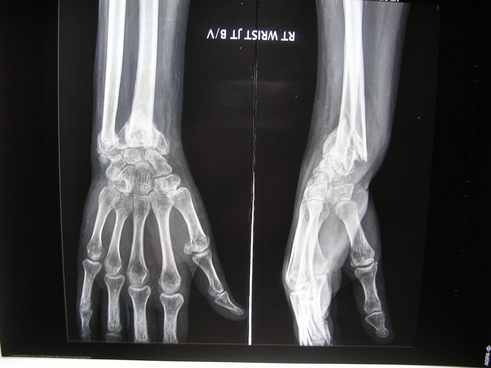 Xrays and Slides malunion of distal radiusulna fracture with