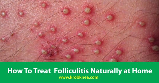 How To Treat Folliculitis Naturally At Home Krobknea