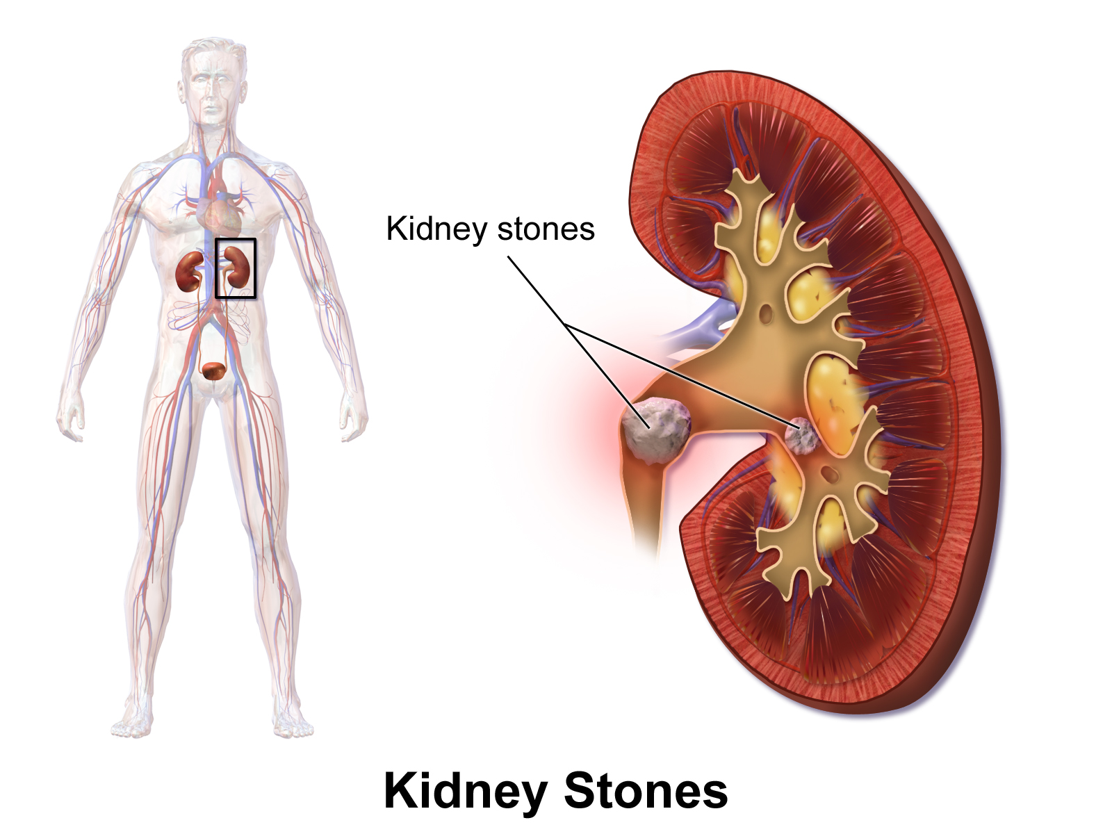 http://1.bp.blogspot.com/-tcQf8AM3s2U/VGMFUZEAXSI/AAAAAAAAA1I/1ZUmbFNNubI/s1600/KidneyStones.png