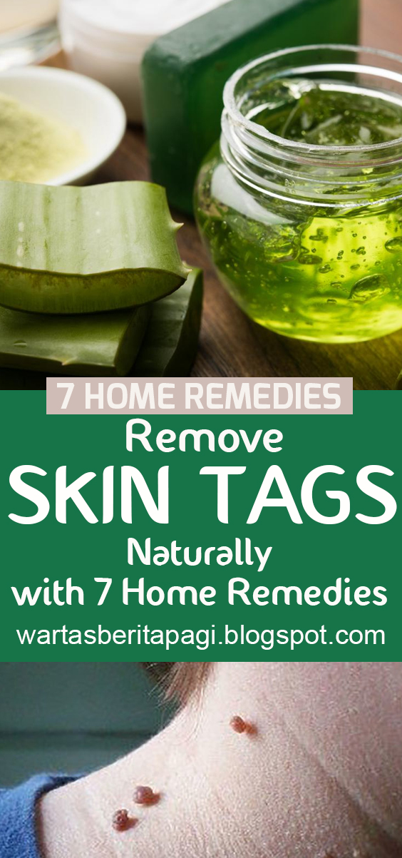 Remove Skin Tags Naturally with 7 Home Remedies | homemade remedies, natural remedies, Diet and nutrition, diet, healthy food, weight loss, nutrition, medical, ketogenic diet, low carb recipes, medical treatment, natural remedies, healthy drink. #skintagsremoval #homeremedies #healthyskin #naturalremedies Remove Skin Tags Naturally with 7 Home Remedies | homemade remedies, natural remedies, Diet and nutrition, diet, healthy food, weight loss, nutrition, medical, ketogenic diet, low carb recipes, medical treatment, natural remedies, healthy drink. #skintagsremoval #homeremedies #healthyskin #naturalremedies