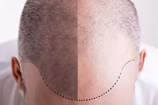 iron deficiency hair loss iron deficiency hair loss