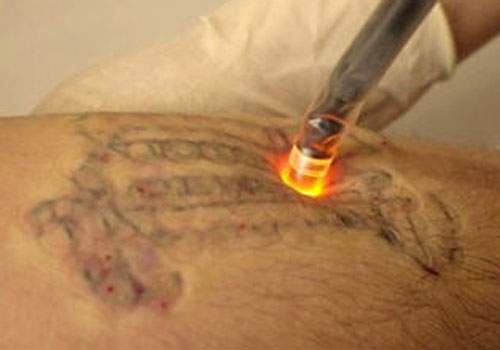 Erase Tattoo Removal: Laser Tattoo Removal: The Process