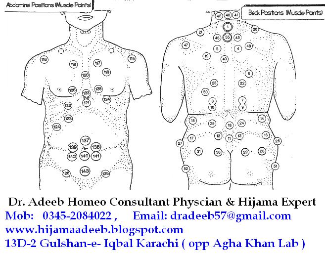 Банки на печень. Схема хиджама точки. Кровопускание хиджама точки схема точки. Точки хиджама атлас точек. Хиджама точки по Сунне атлас точек.