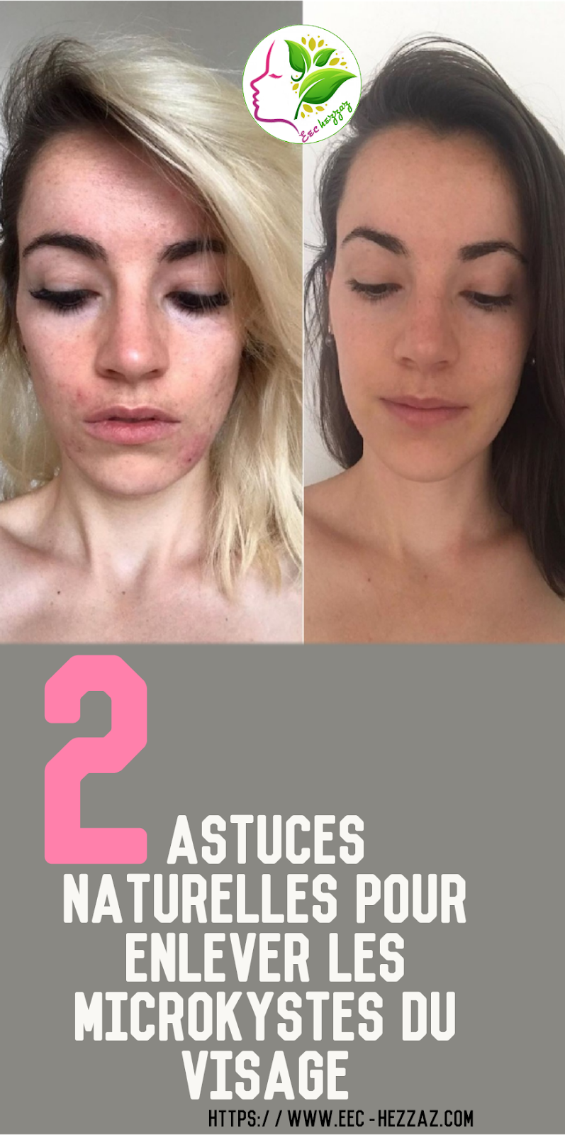 2 astuces naturelles pour enlever les microkystes du visage
