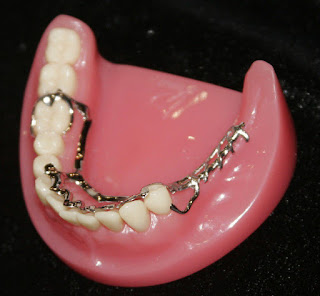 Giải pháp cho những người bị mất nhiều răng cần biết