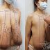 Người phụ nữ Sài Gòn 31 tuổi khổ sở vì ngực dài nửa mét
