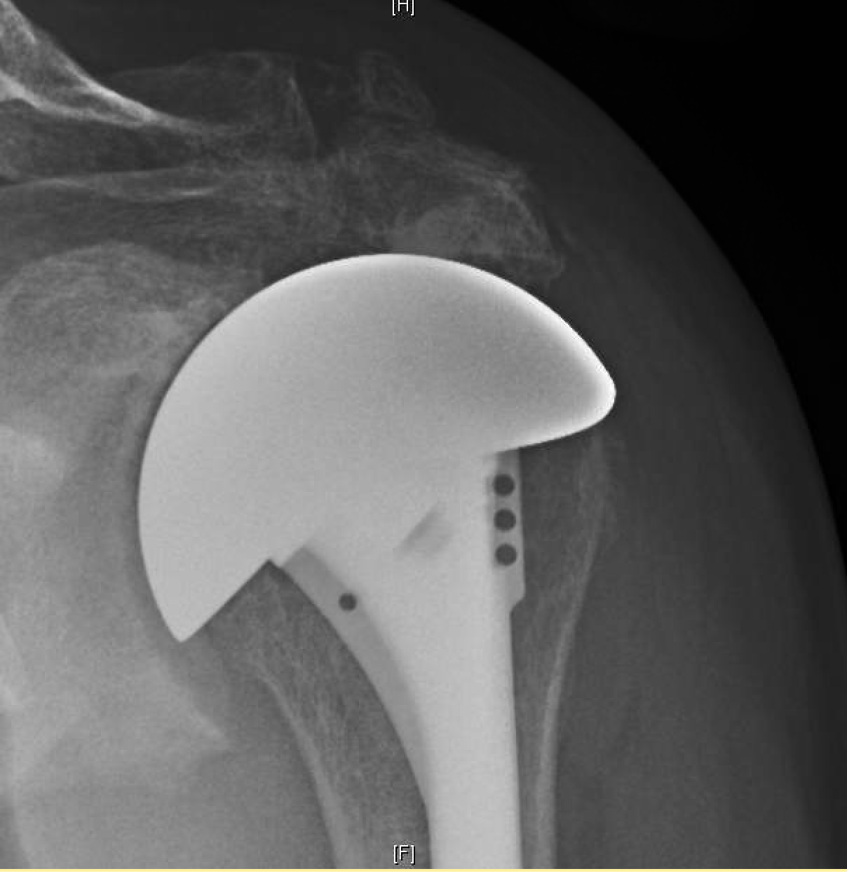 UW Shoulder and Elbow Academy Irreparable rotator cuff tear operative management