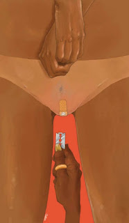 Female Genital Mutilation (FGM) in Africa