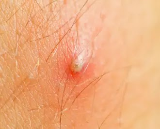 Online Free Solution What Do White Spots On Testicles Mean