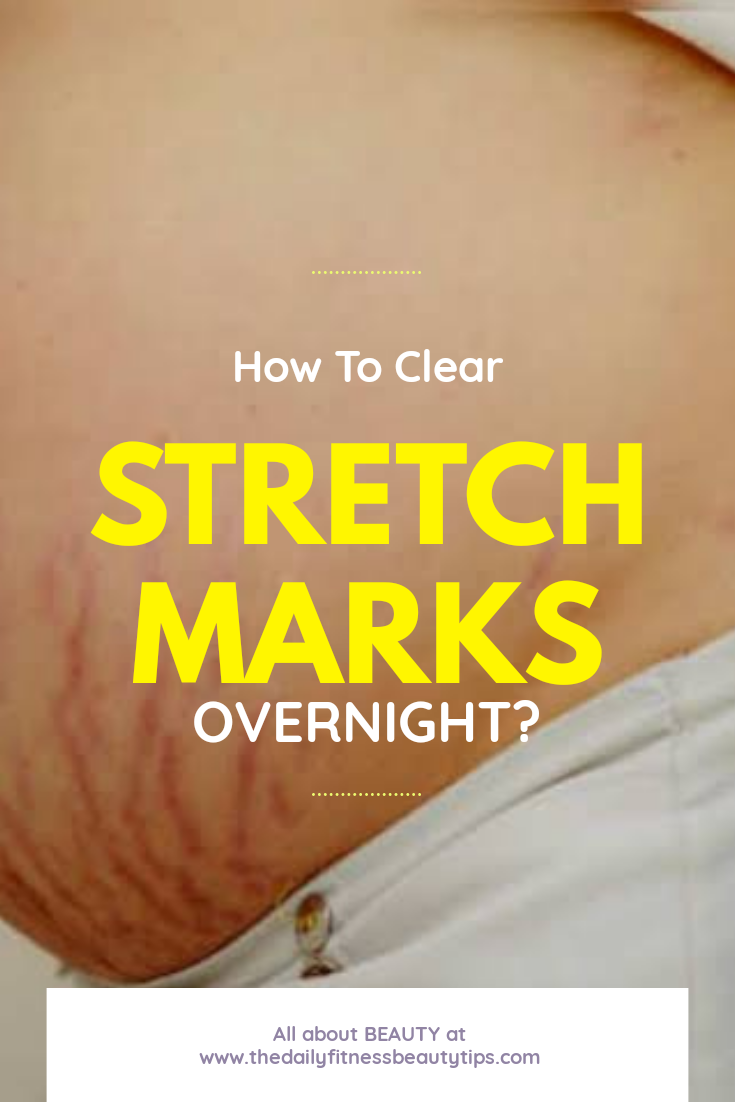 Best Way To Clear Stretch Marks Permanently.