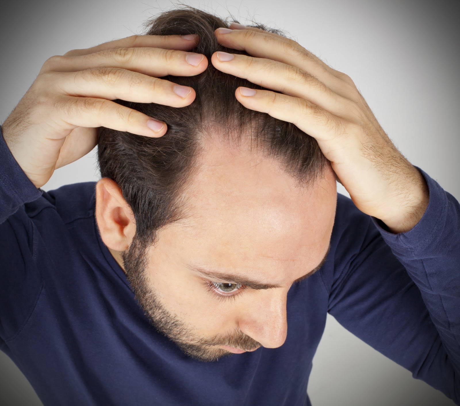 Male Pattern Baldness In Men And How To Treat It Hair Loss Treatment