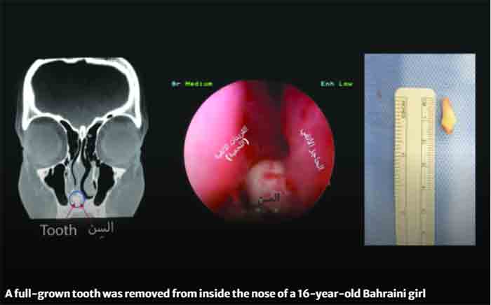 Tooth Tooth removed from inside nose of girl, 16, Manama, Bahrain, Hospital, Treatment, Girl, Gulf, World
