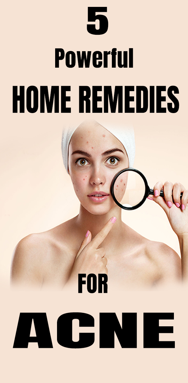 5 Powerful Home Remedies for Acne