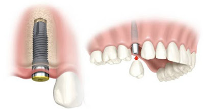 Trồng Implant nha khoa giá bao nhiêu?