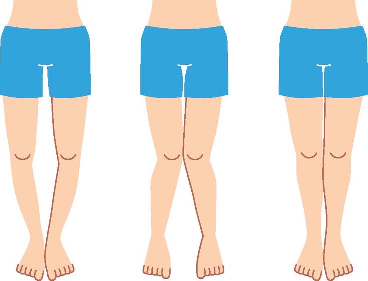 General Health Info Causes of Bowleggedness and all treatment options.