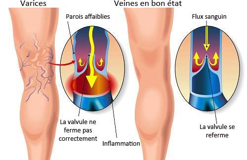 Remède maison à l'aloe vera et au miel pour enlever les varices