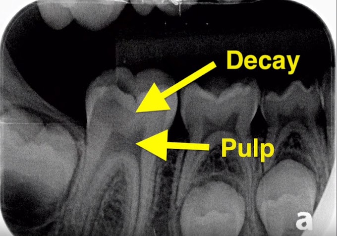ENDODONTICS: Deep Tooth Cavity - Healed Tooth without a Root Canal