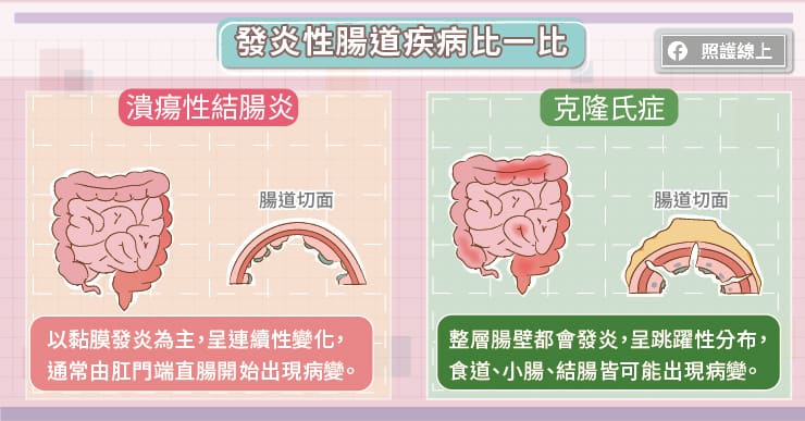 發炎性腸道疾病比一比