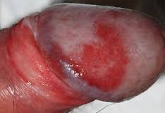 Ujung Penis Berwarna Merah dan Bengkak Serta Solusi Pengobatannya Ujung Penis Berwarna Merah dan Bengkak Serta Solusi Pengobatannya