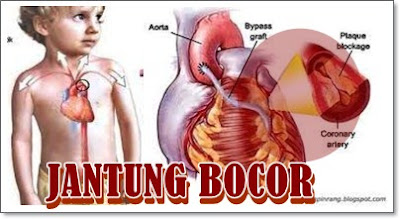 Pengobatan Tradisional Penyakit Jantung Bocor