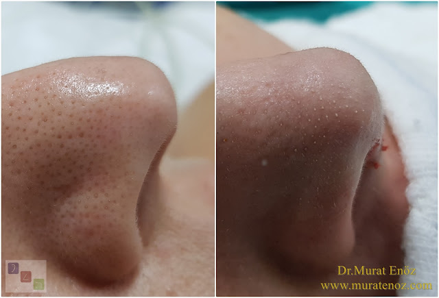 Nose tip plasty with nasal hump reduction operation in İstanbul - Nose tip lifting in İstanbul - Tip plasty in İstanbul - Nose tip reshaping in İstanbul - Nose tip surgery in Turkey - Open technique tip plasty operation in İstanbul