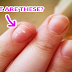 White Spots On Your Nails: What They Causes And Really Mean For Your Health