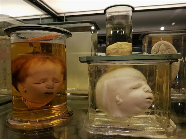 أجنة مشوهة في متحف بالقصر العيني أجنة مشوهة في متحف بالقصر العيني