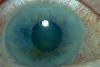 Eye diseases best information 2020