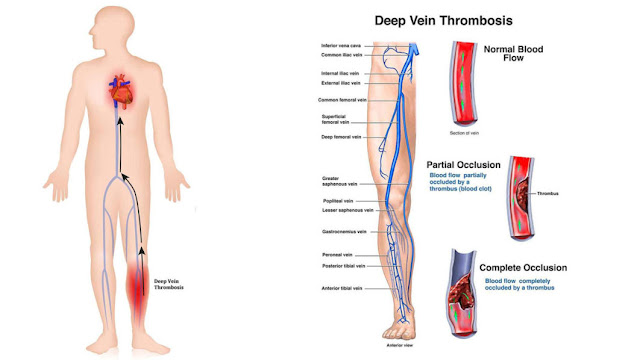 What is Deep Vein Thrombosis