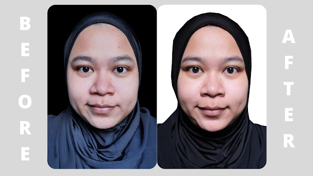 Before After ERHA Ultimate Acne Treatment
