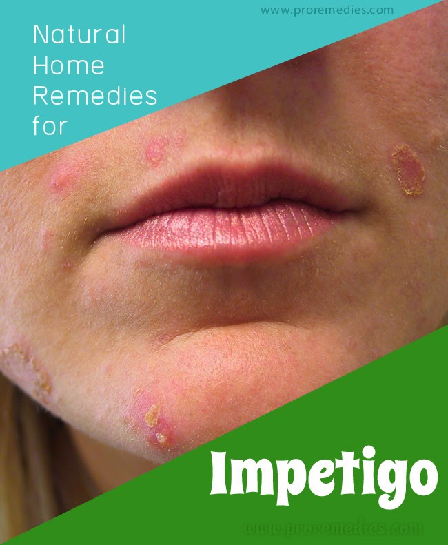 Gum Recession Home Remedies Lip Rash Home Remedies