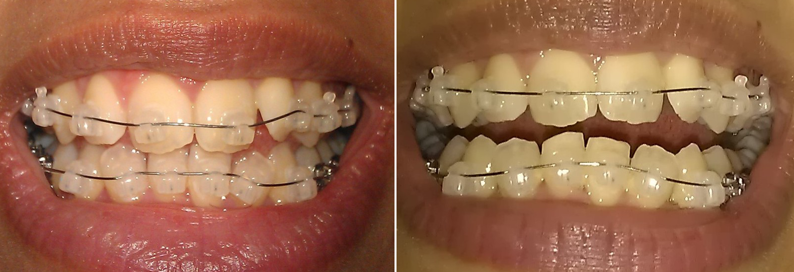 My Damon Clear Braces Day 30 with Damon Braces and 'before and after