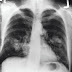What is tuberculosis and its symptoms